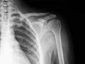Mujeres y hombres están en riesgo de fractura por osteoporosis
