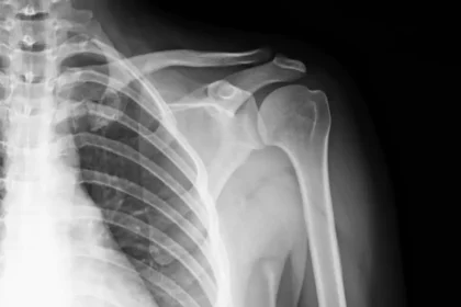 Mujeres y hombres están en riesgo de fractura por osteoporosis